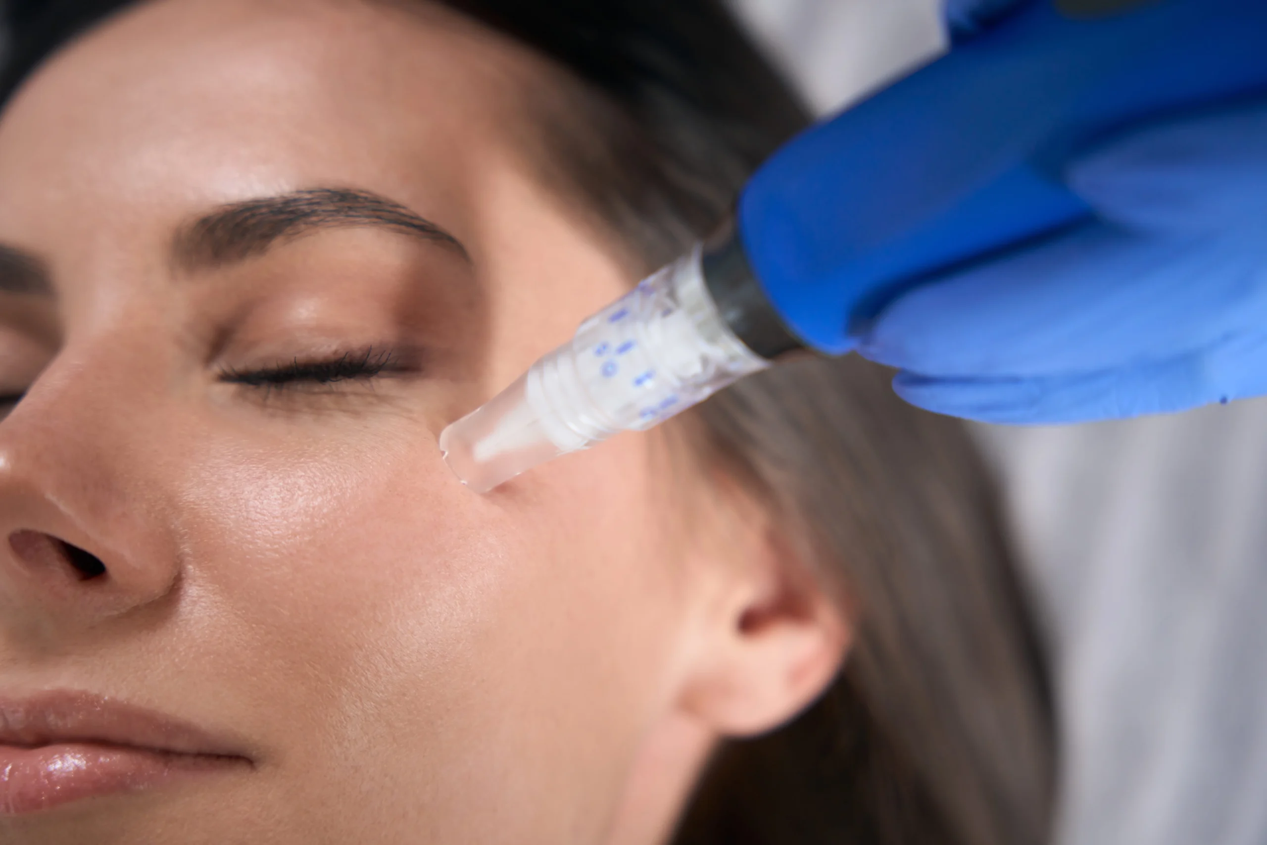 a woman getting a SkinPen® Microneedling with PRF treatment | Fayced Aesthetics | NYC