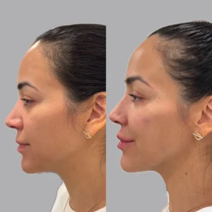 Full Face Restoration treatment for skin | before and after photo | Fayced Aesthetics NYC | New York, NY