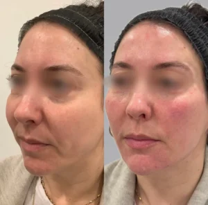 Full Face Restoration treatment for skin | before and after | Fayced Aesthetics NYC | New York, NY