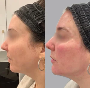 Full Face Restoration treatment for enhancing skin texture | before and after | Fayced Aesthetics NYC | New York, NY