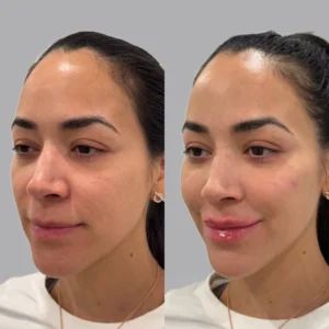 Full Face Restoration treatment for skin radiance | before and after | Fayced Aesthetics NYC | New York, NY
