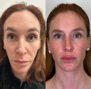 Full Face Restoration treatment for skin texture | before and after | Fayced Aesthetics NYC | New York, NY