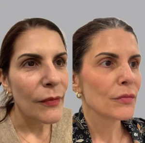Full Face Restoration treatment | before and after photo | Fayced Aesthetics NYC | New York, NY